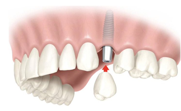 ¿Qué son los Implantes Dentales?