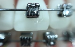 tratamiento de la ortodoncia