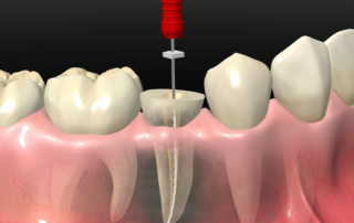 Cómo se realiza una endodoncia